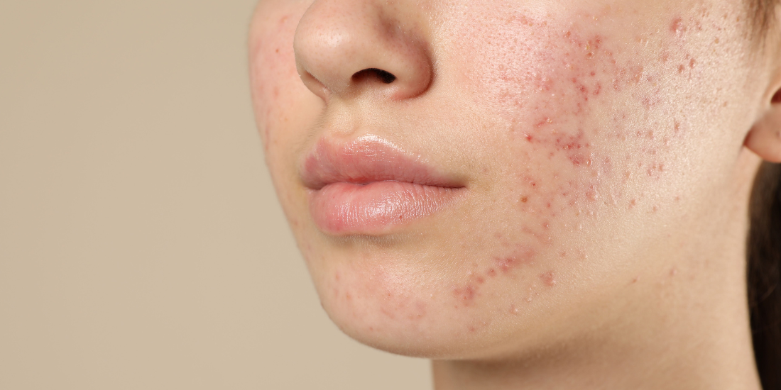 Pregnancy Skin Issues & Pregnancy Safe Skincare 